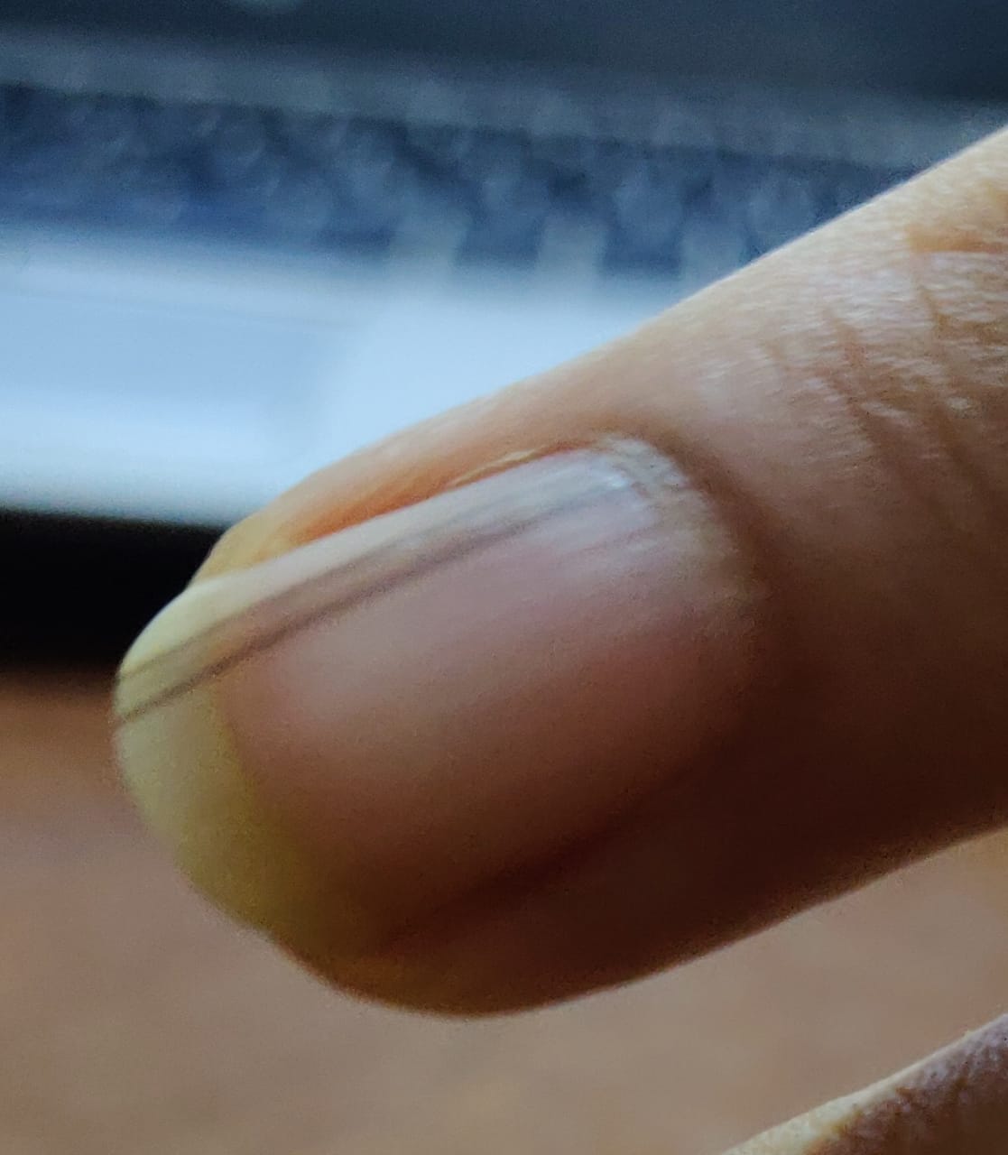 Nail Streaks Getting Darker With Time
