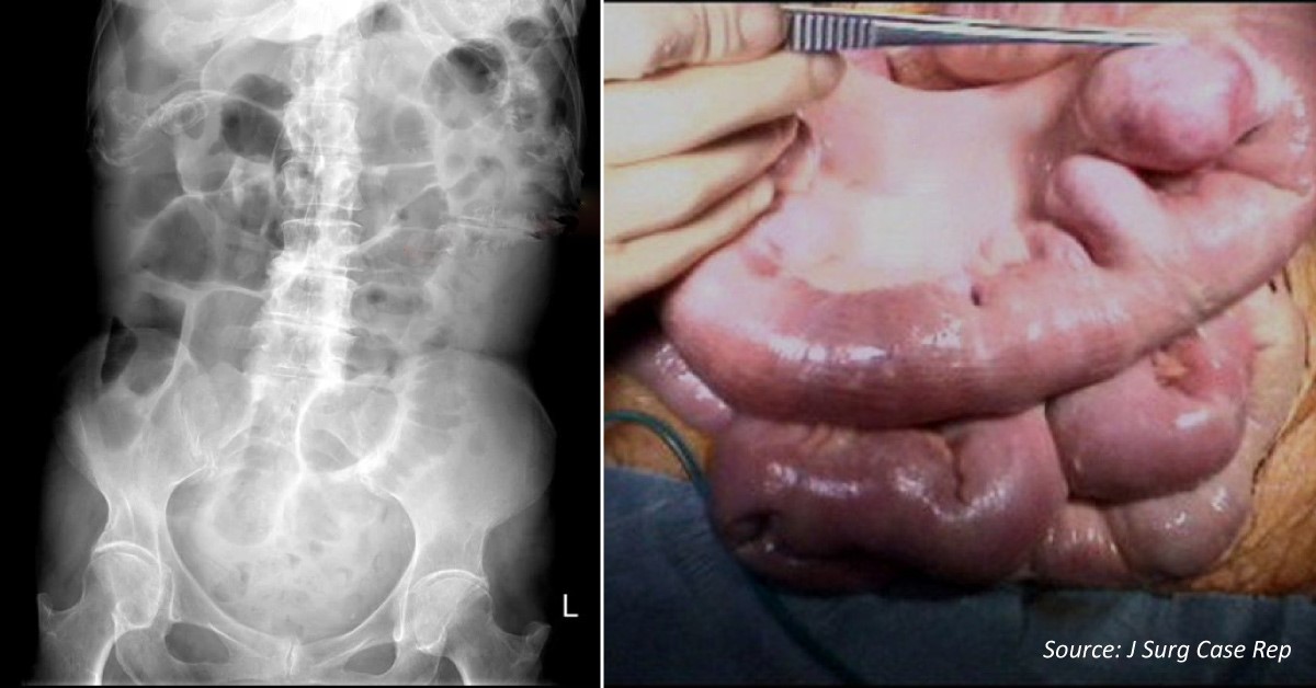 A Case of Non-specific Abdominal Pain