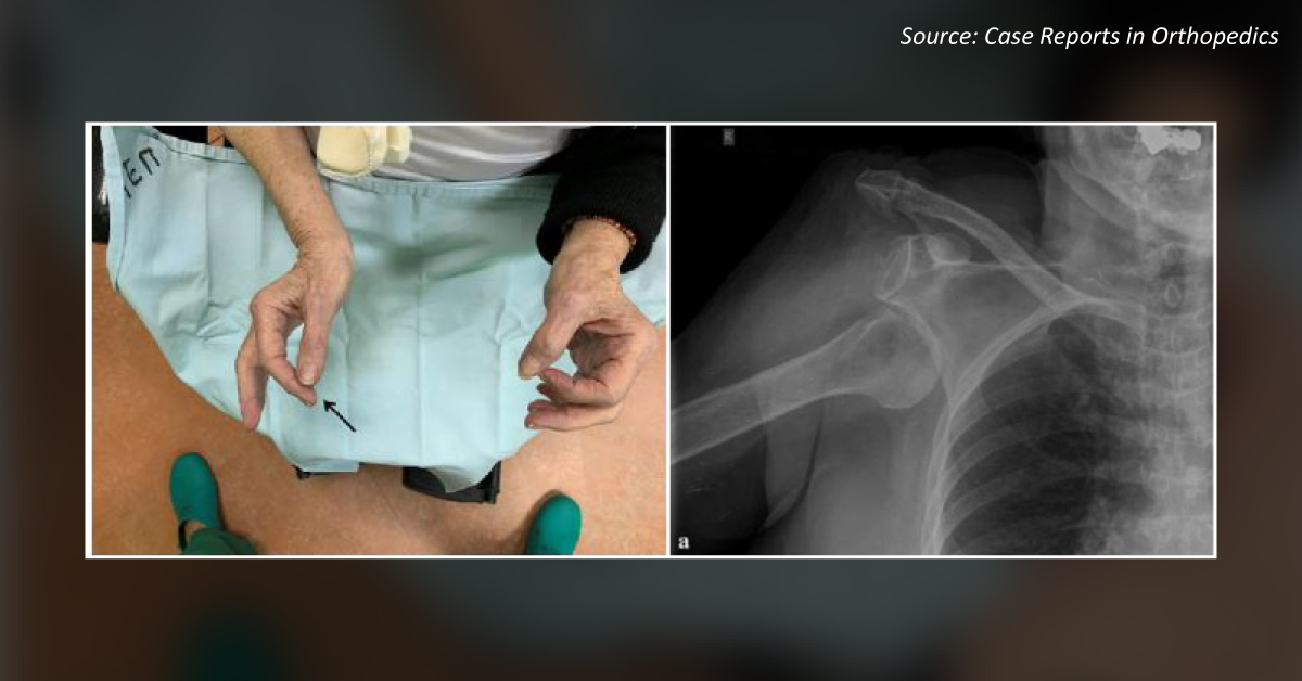 An Elderly Female With Shoulder Pain Due To An Accidental Fall