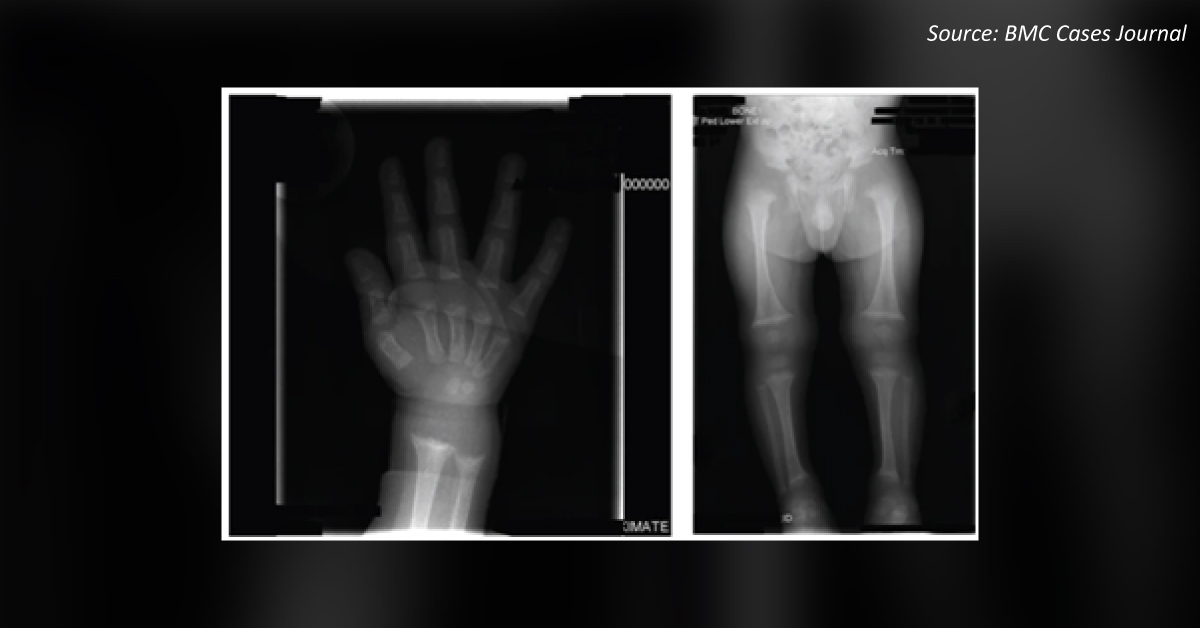 An Infant with Nutritional Deficiency: Can You Diagnose the Case?