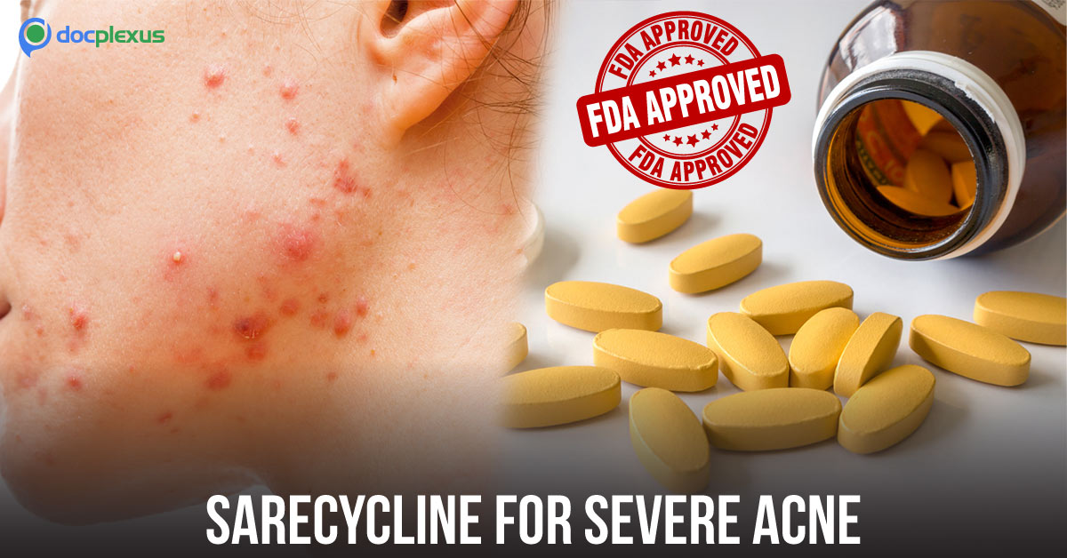 FDA Approves A Tetracycline-Derived Antibiotic For Teenage Acne