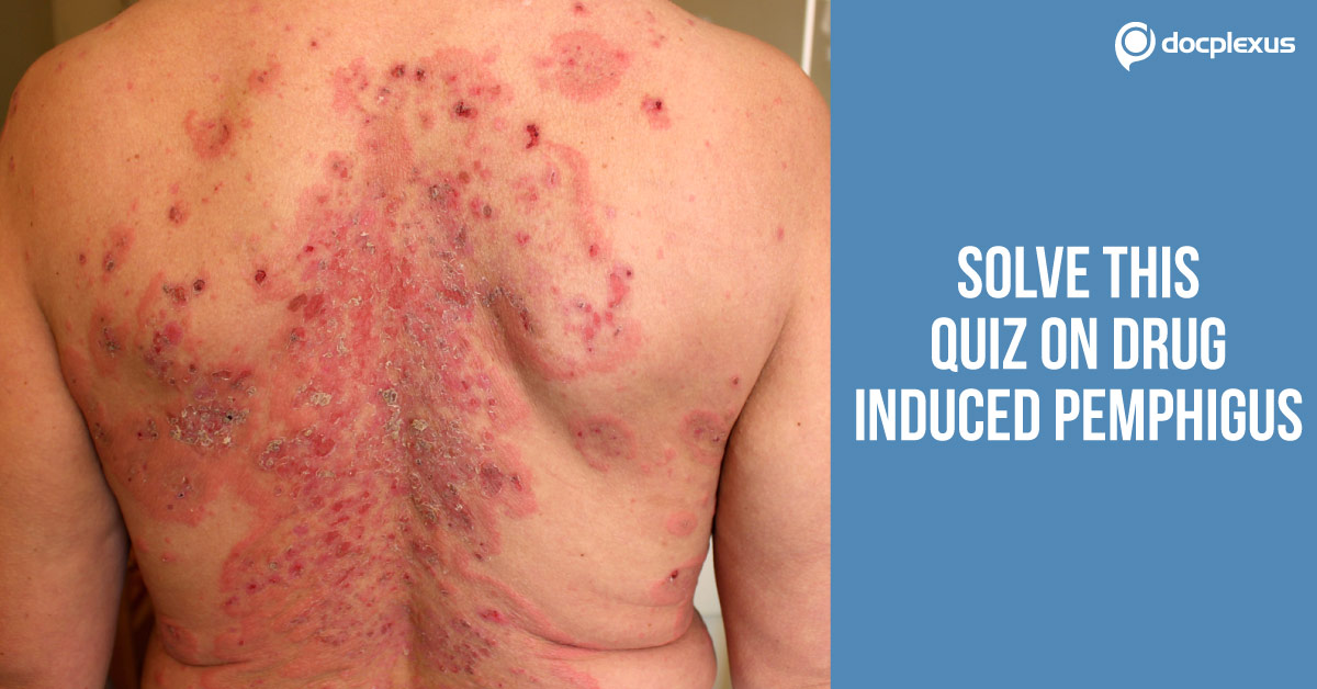 Drug-Induced Pemphigus - When The Skin Is Allergic To Drugs