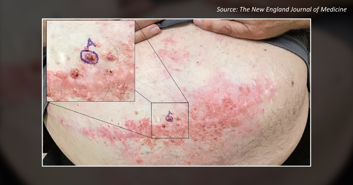 What is Causing These Skin Lesions?