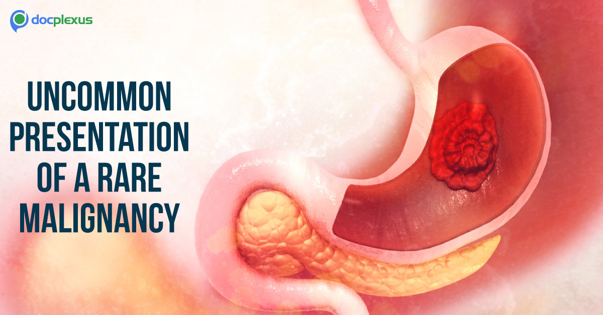 Primary Gastric Squamous Cell Carcinoma: A Rare Malignancy