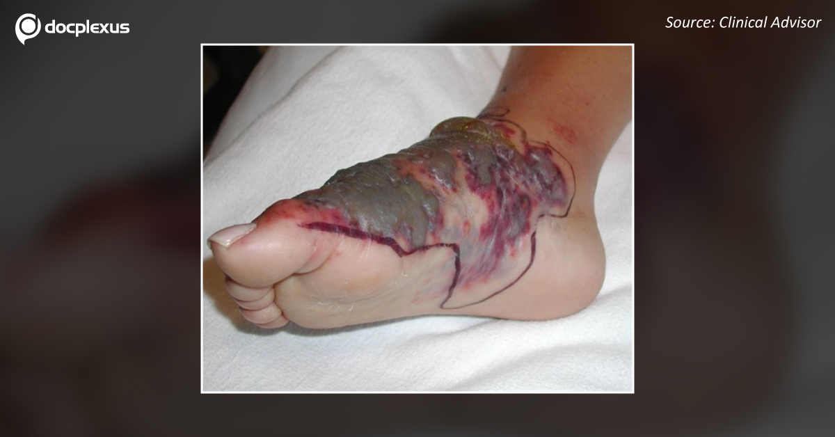 A Purple Plaque on the Foot Post Injury While Swimming