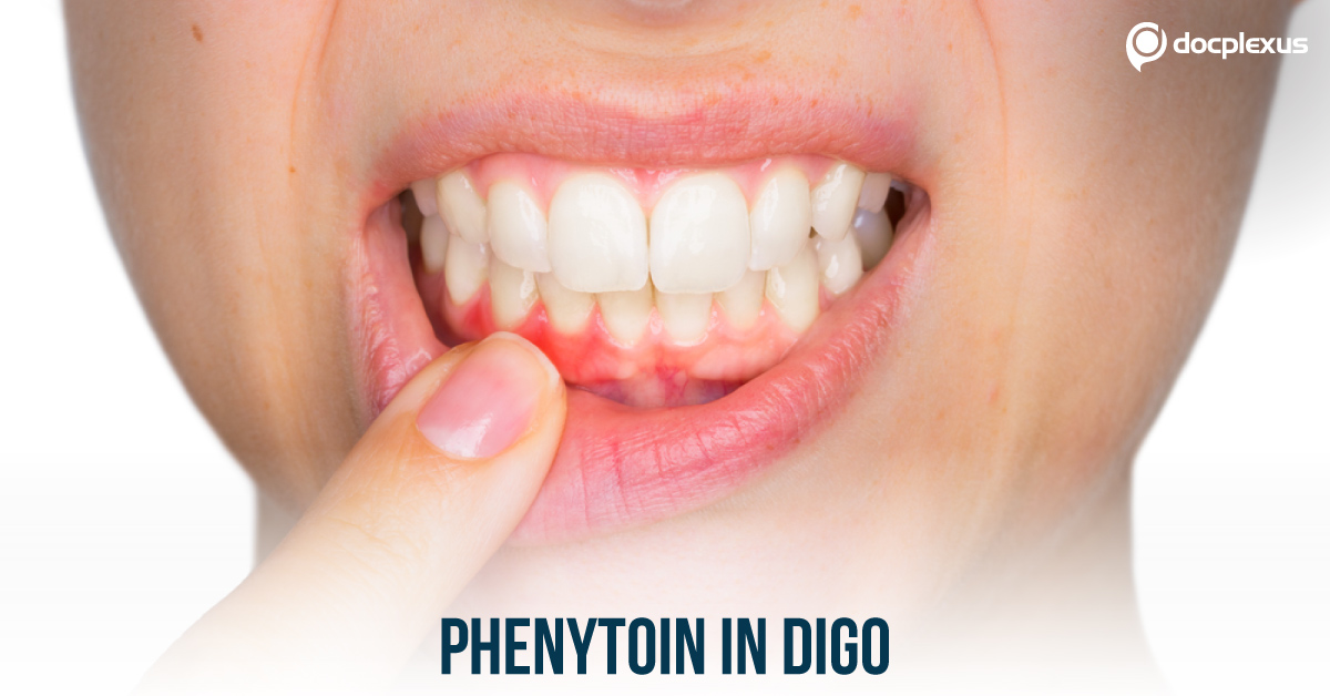 Drug-induced Gingival Enlargement in Epileptic Patients