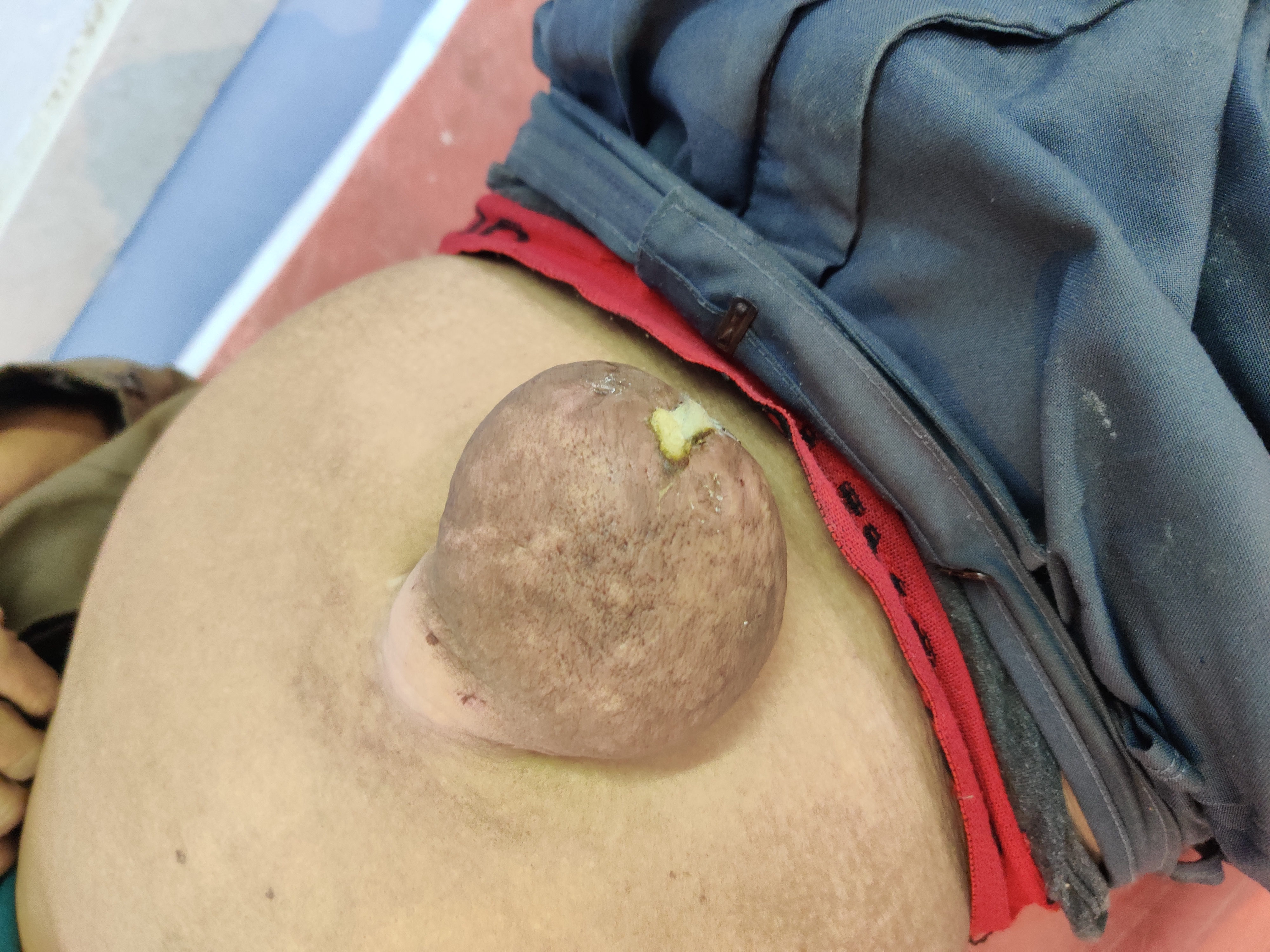 Case Of Male With Ascites