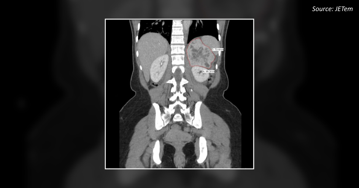 Hypertension and Chest Pain, What Can Be the Probable Diagnosis?