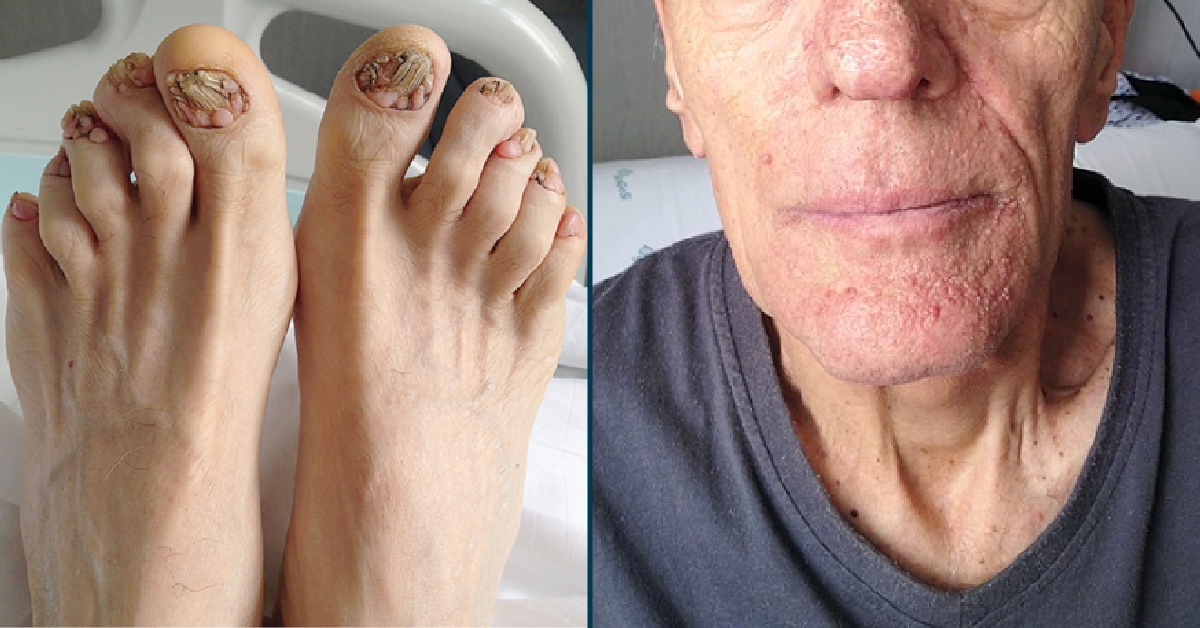 What Is The Reason Behind These Papules?