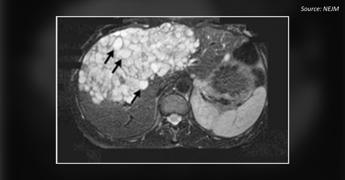 A Case of Abdominal Discomfort
