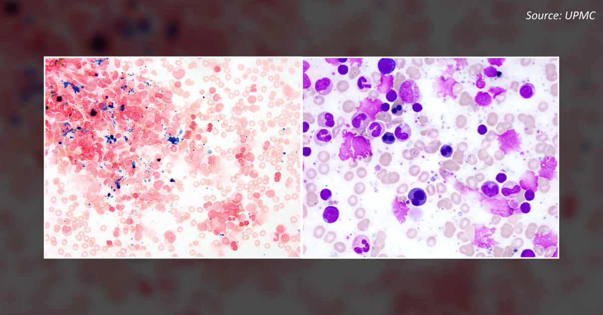 An Infant with Persistent Anemia