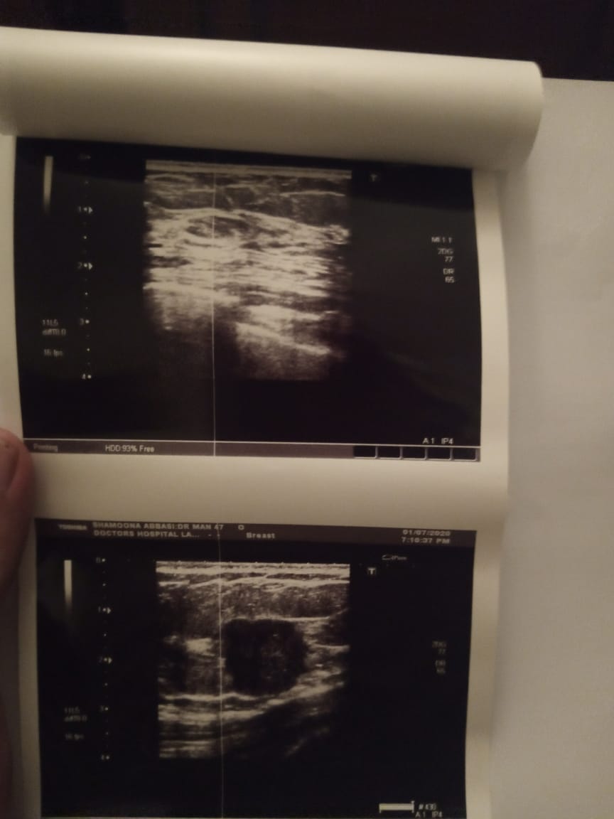 Irregular Solid Mass In The Right Breast