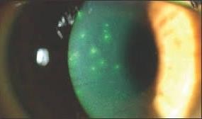 Adenoviral Keratitis And Treatment In Misdiagnosed Patients: A Follow-up Report Of The Case Series