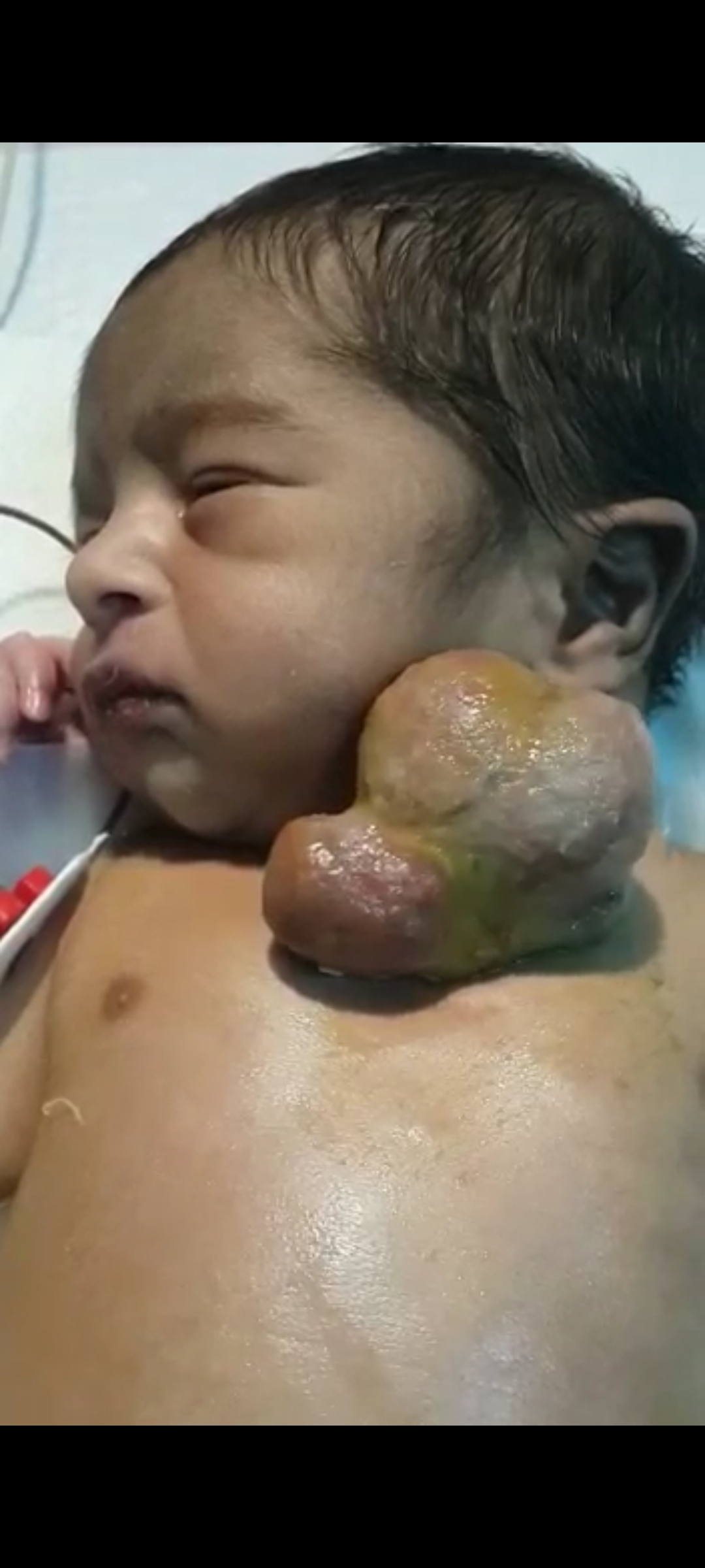 Rare Case Of Ectopia Cordis