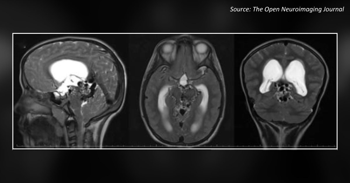 A Young Boy with Progressive Headache: What is the Diagnosis?