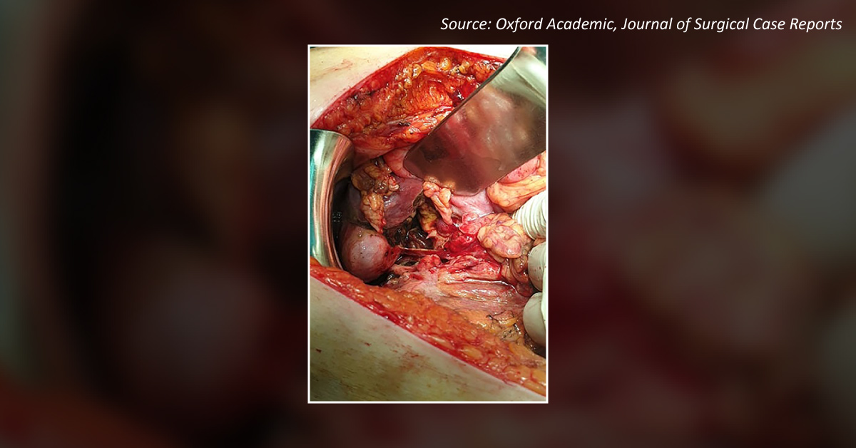 Diagnose the Cause for This Gastrointestinal Condition After Surgery