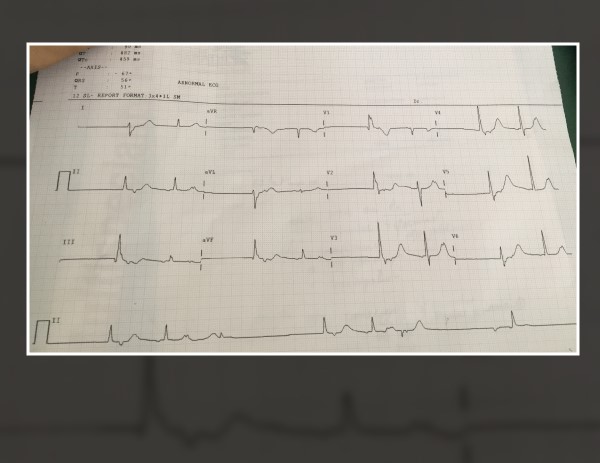Patient Case With No Presyncope