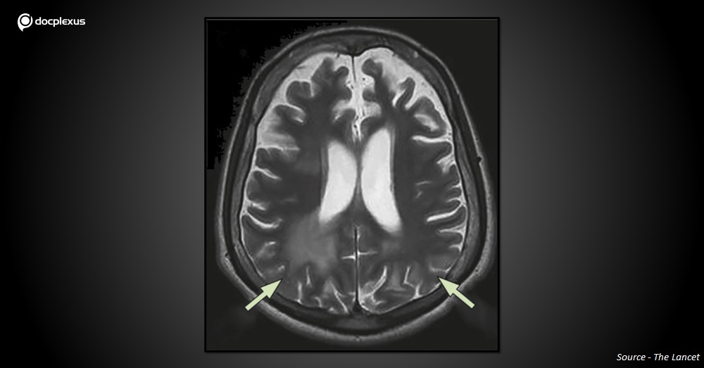 A Young Man with Epilepticus and Seizures
