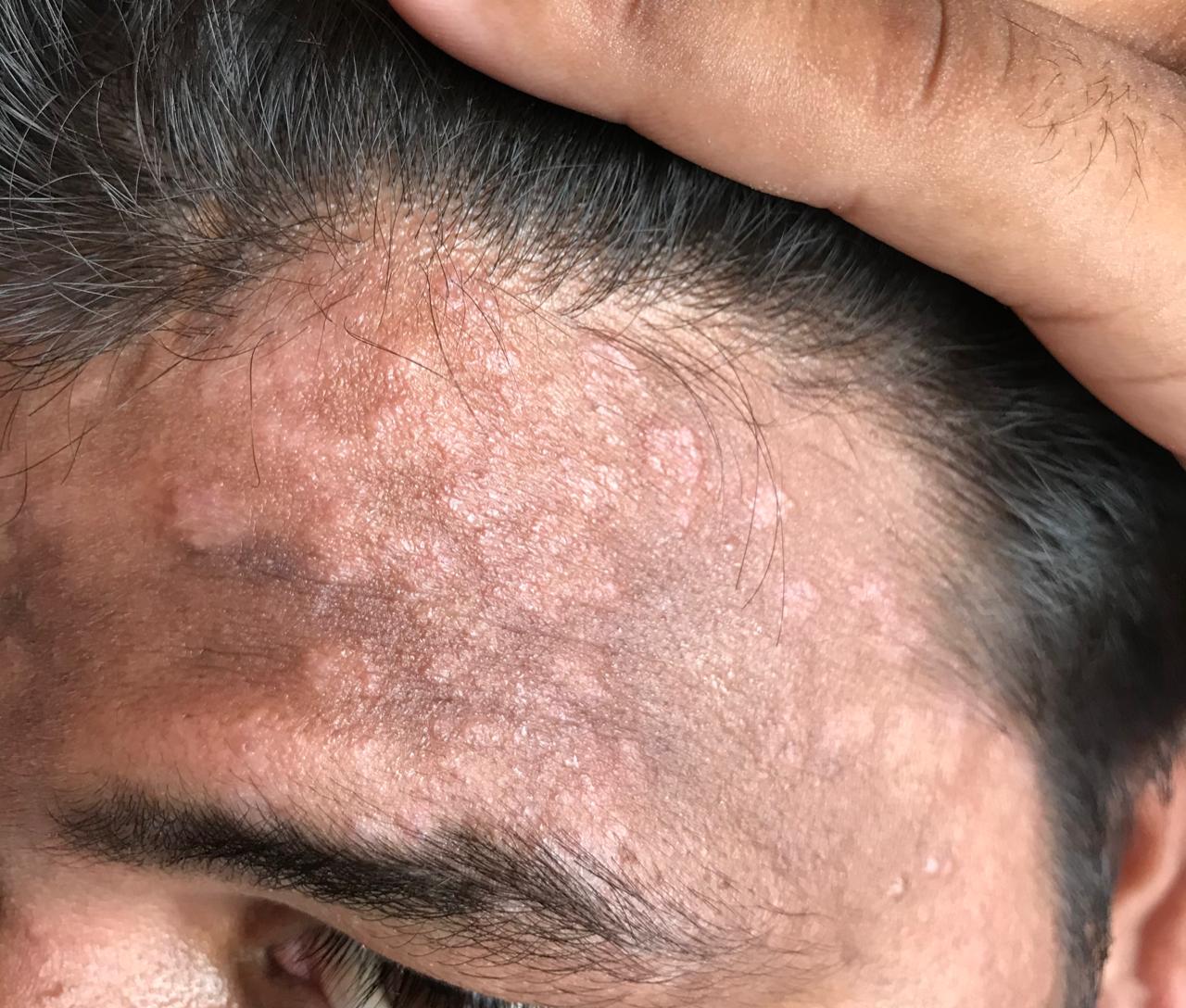 Resistant Fungal Infection Of Whole Body{genitalia, Back, Face, Hands}.
