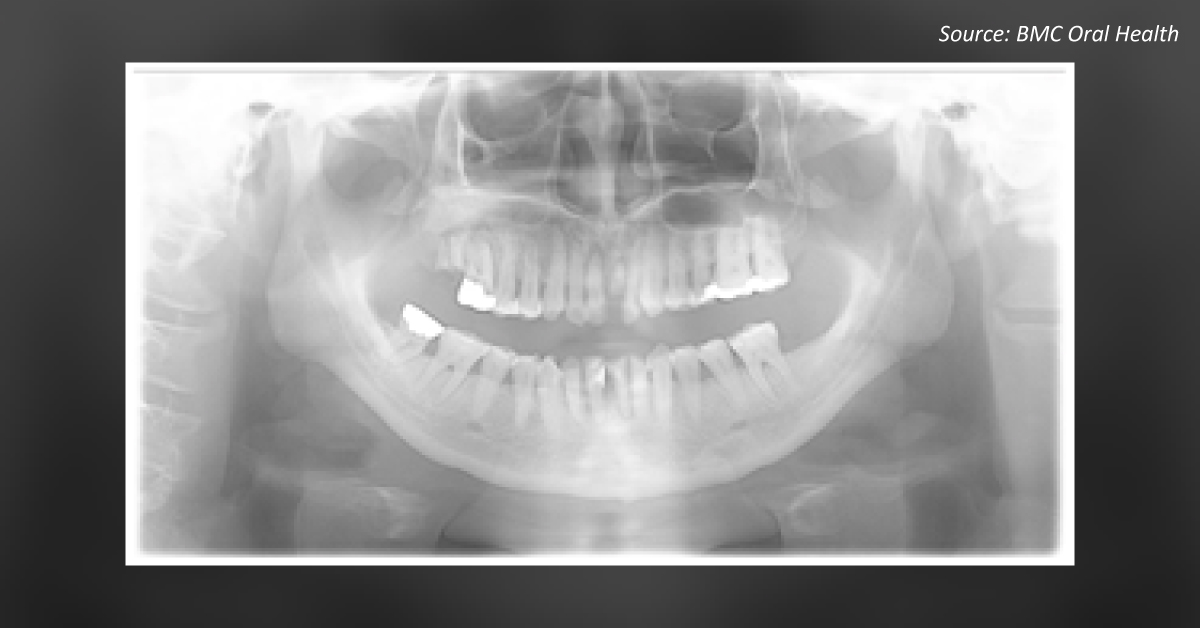 Dental Care Precautions in a Patient with Down Syndrome