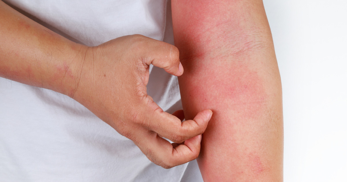 Researchers Call To Make Rashes A Coronavirus Symptom
