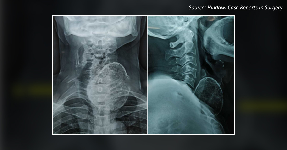 Diagnose This Case of Goiter Enlargement