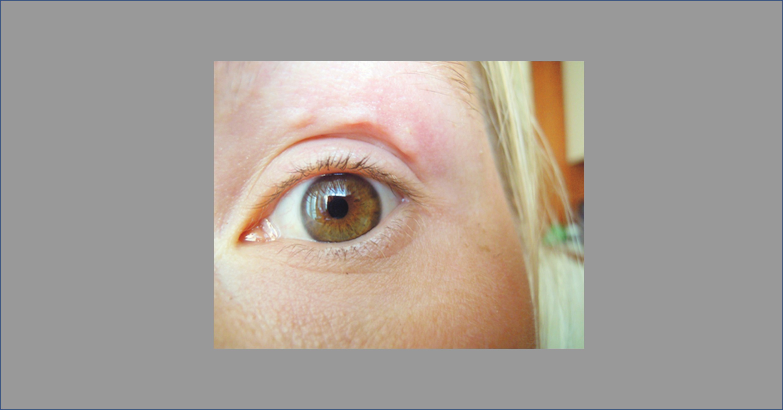 Can You Identify These Nodules Near the Eye?