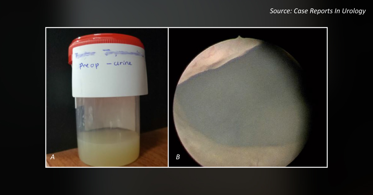 Find the Cause of Milky White Urine in This Patient