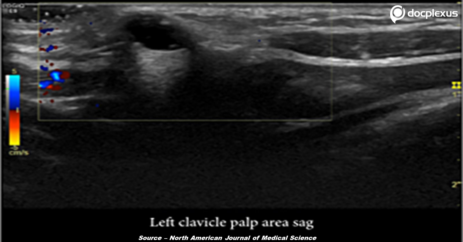 A Rare Case Of Palpable Mass Near Sternoclavicular Joint