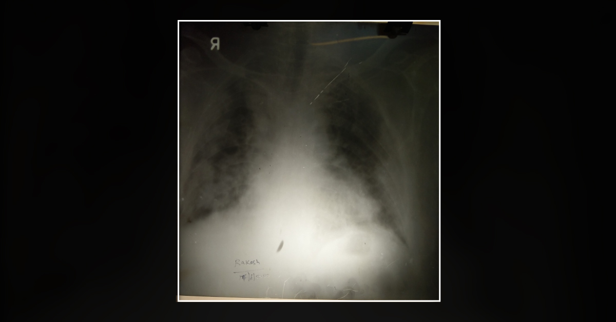 Severe Dyspnoea During Covid Times