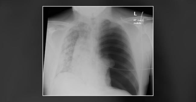 How Will You Manage COVID-19 Patients With Pleuritic Chest Pain?