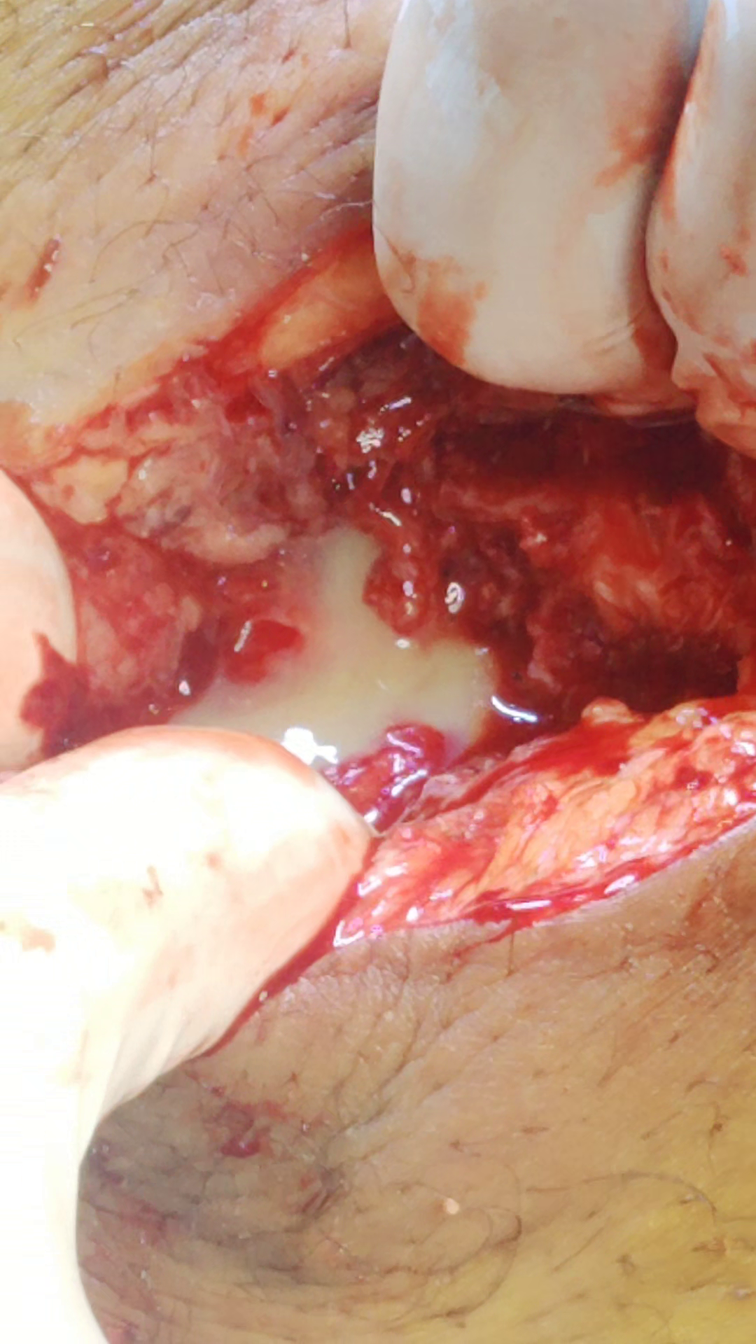Post Laparoscopic Totally Extra-peritoneal (Tep) Inguinal Hernia Repair Cellulitis Of Operation Site