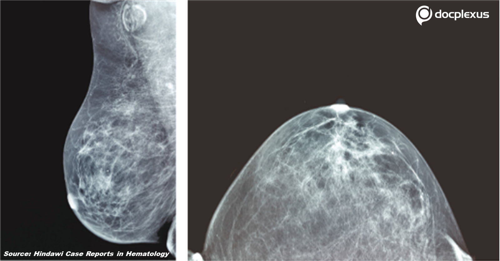 A Rare Hematologic Case with a Diagnostic Challenge