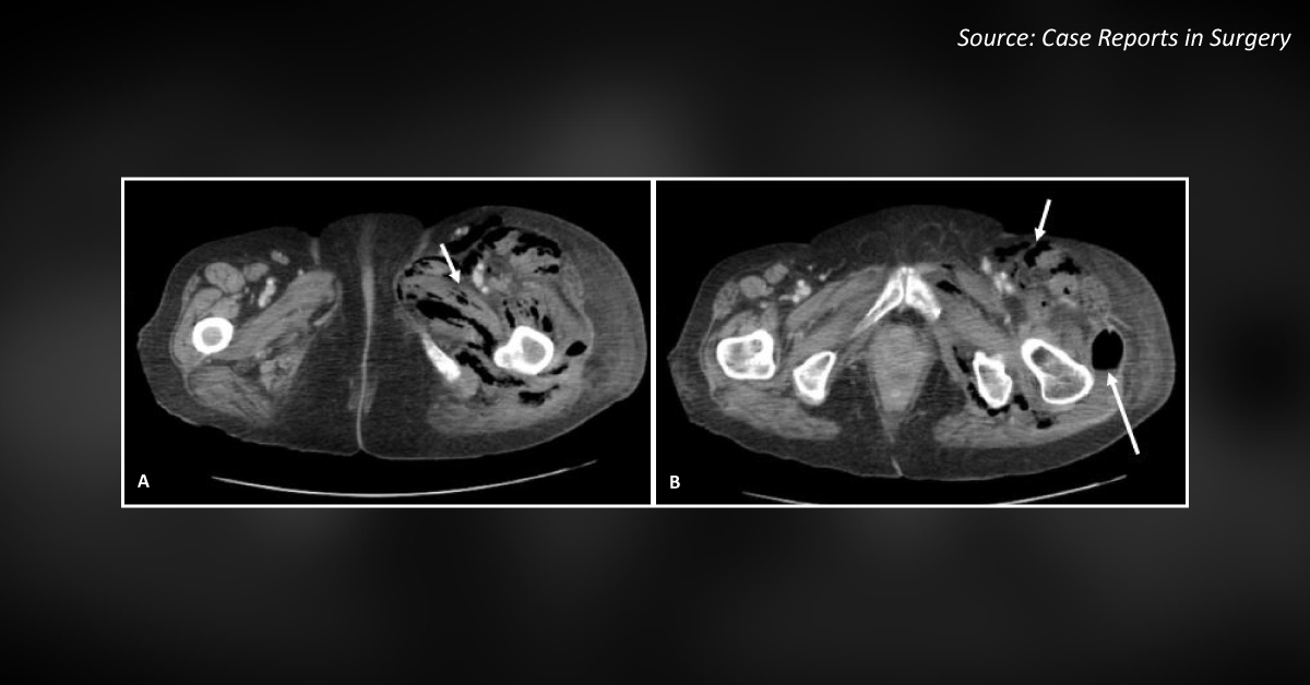 A Case of Major Complications After a Colorectal Resection