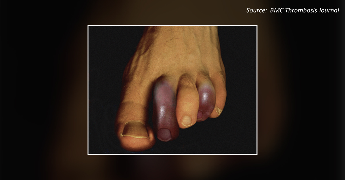Bluish-Purple Discoloration Of The Toes