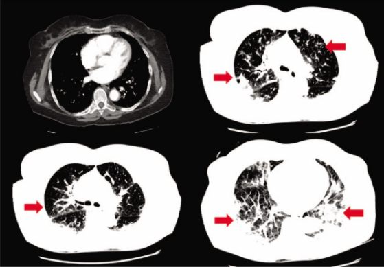 An Elderly Female with Bilateral Ground Glass Opacities in Lungs