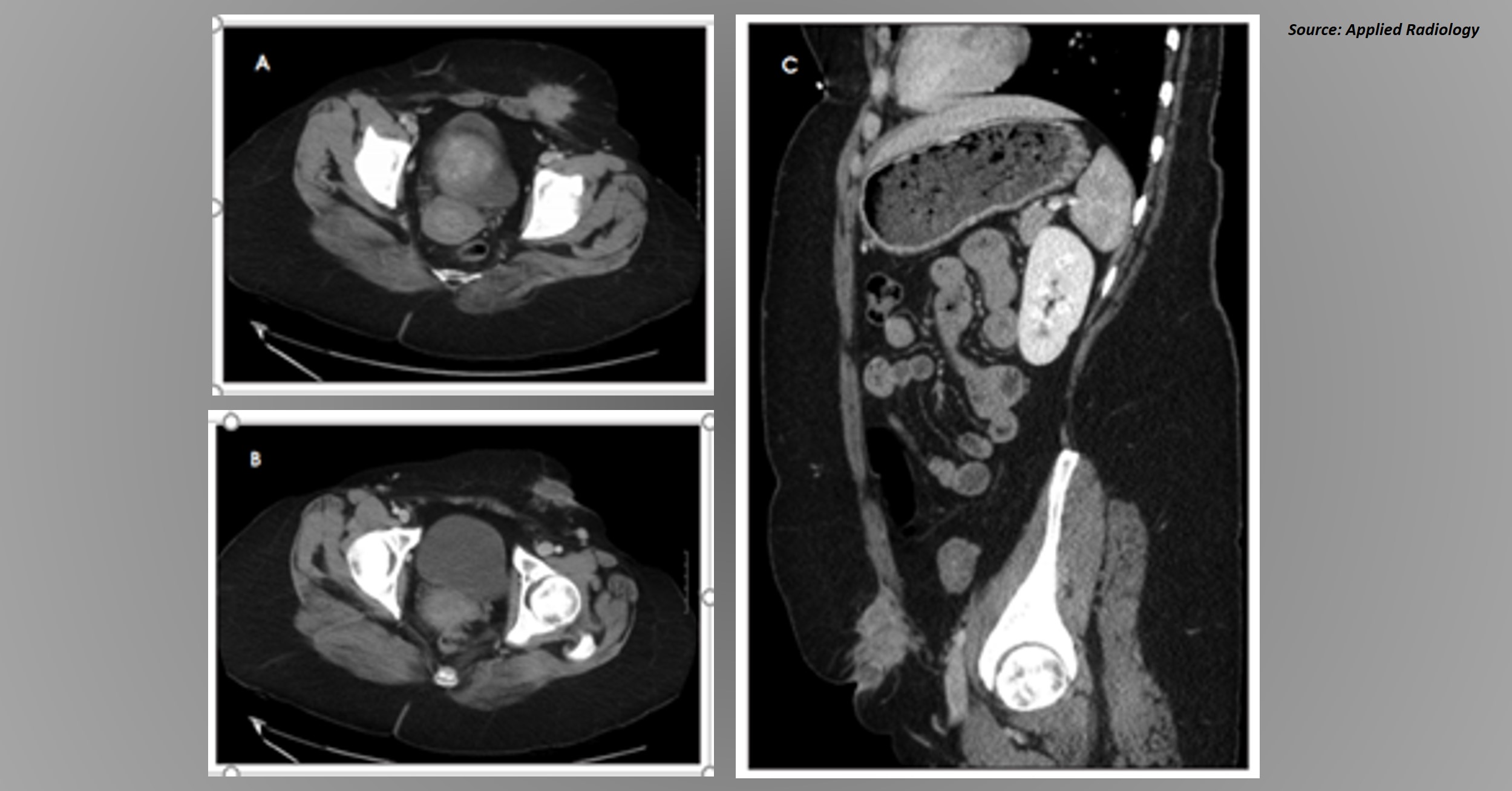A Female with Worsening Cyclical Pain in the Left Lower Quadrant