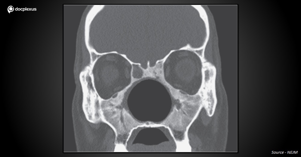Identify The Cause of Nasal Deformity In This Man