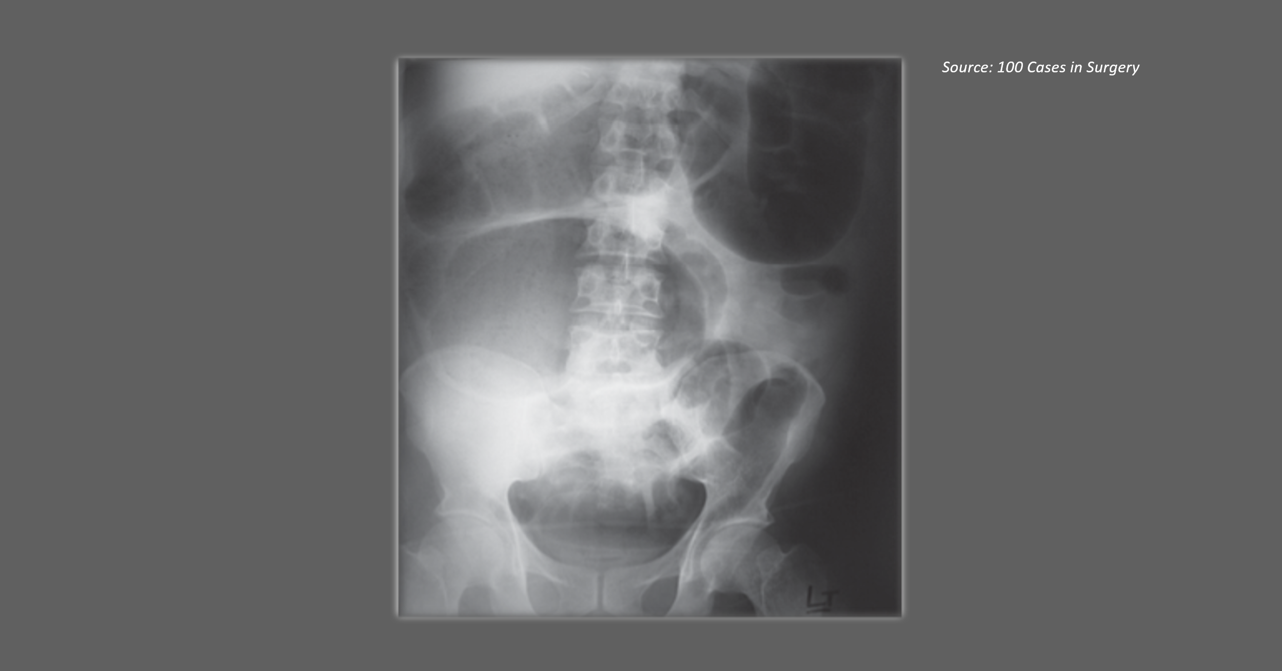 Post-surgery Abdominal Complications in an Old Man