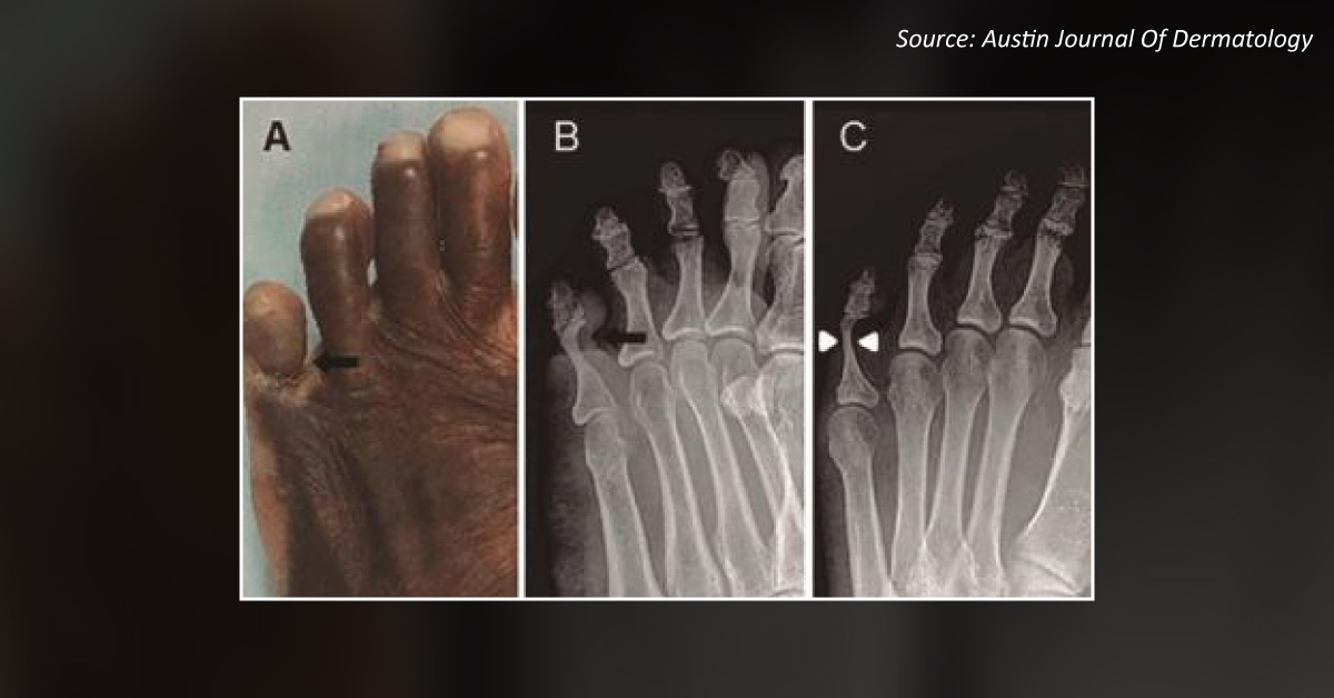 Case of an Elderly Man with a Groove on the Left Fifth Toe