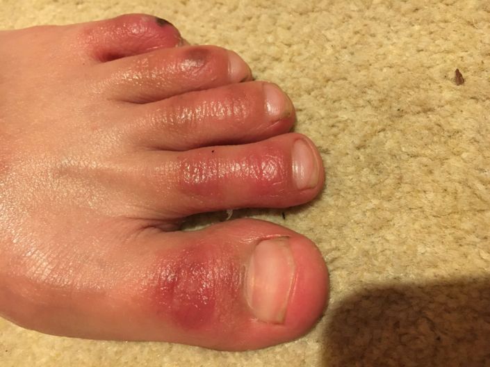 New Skin Lesions Related To Covid-19 Patients