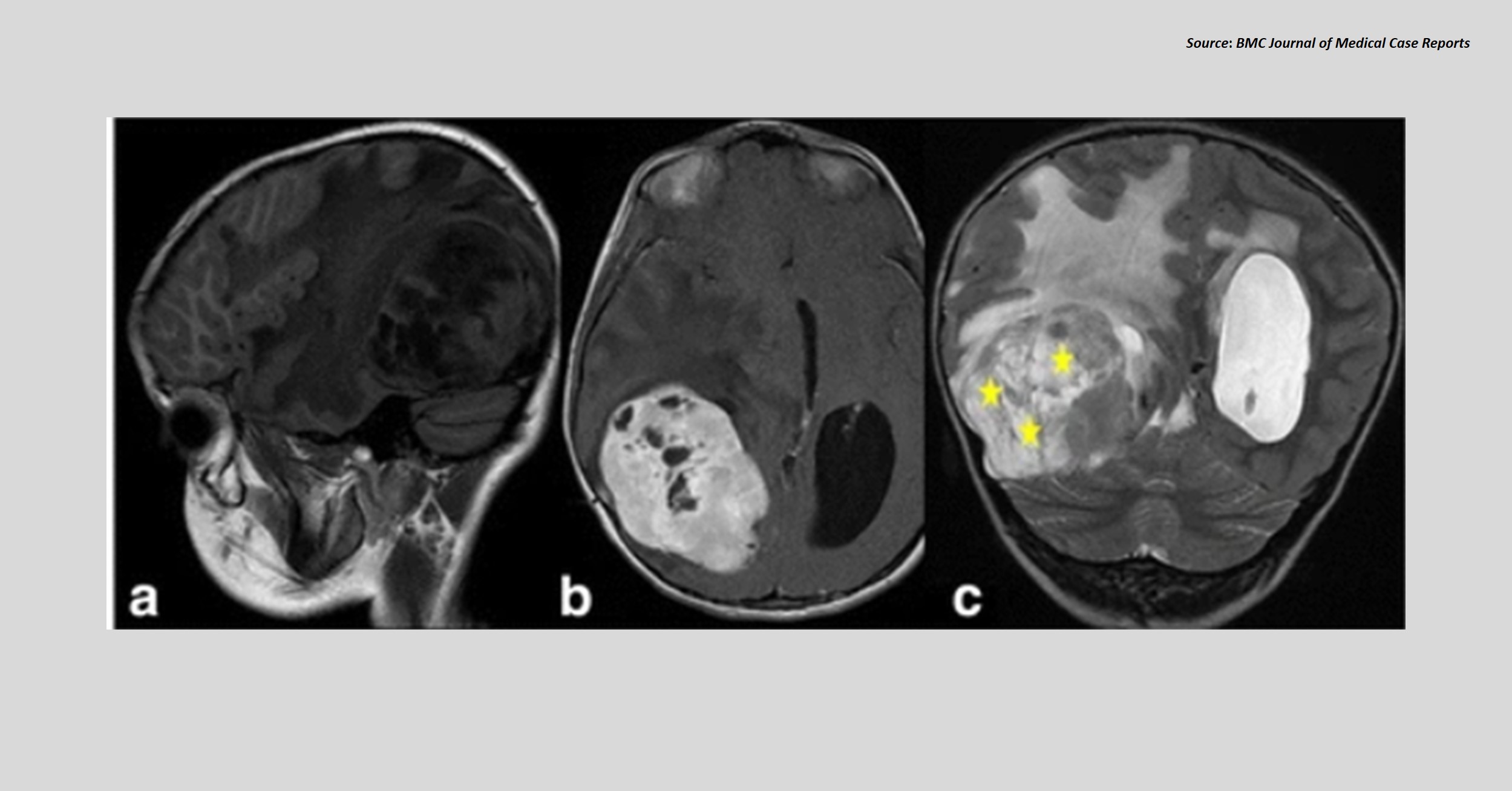 A Young Girl with Epileptic Seizures and Decreased Visual Acuity