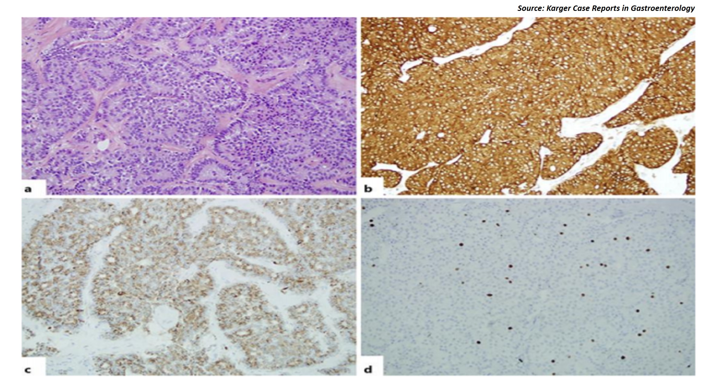 A Case of Rare Neuroendocrine Tumor