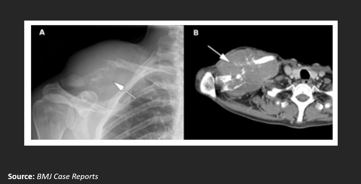 A Case Of Hepatocellular Carcinoma In A Middle-Aged Man
