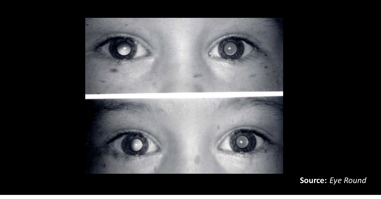 Case of a Young Boy with Impaired Vision