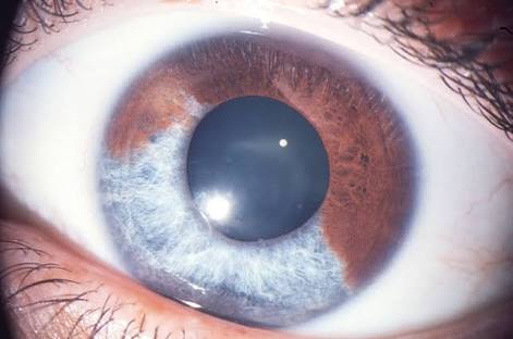 Diagnose This Eye Condition