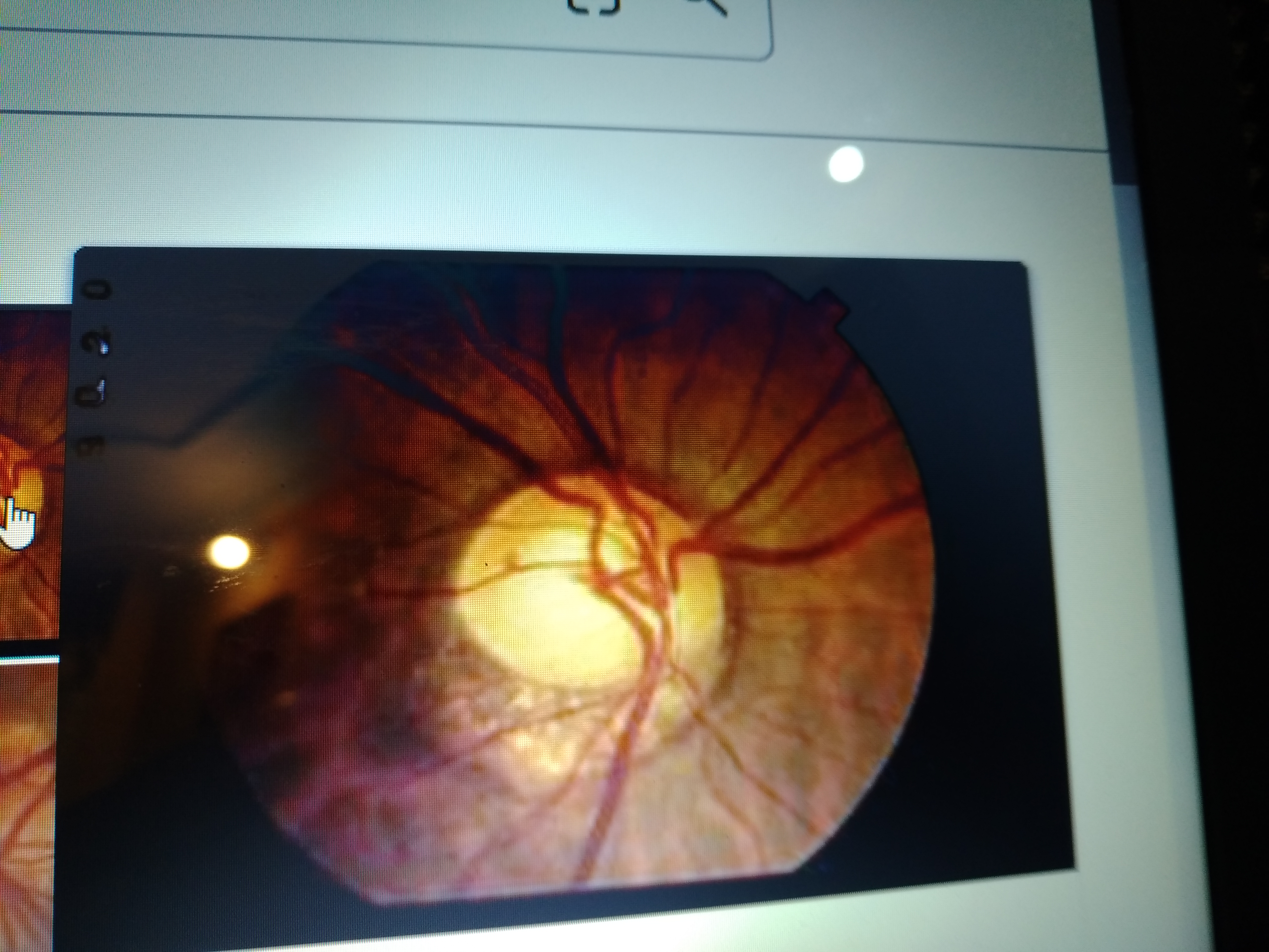 Diagnose This Retinal Abnormality
