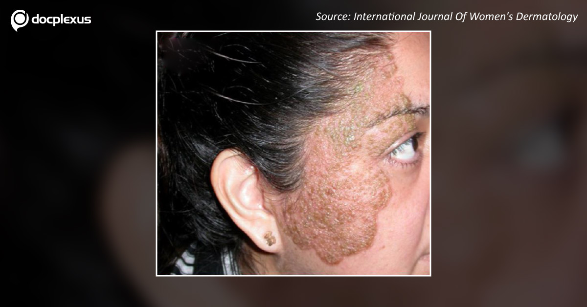 What Are The Eruptions On The Face?