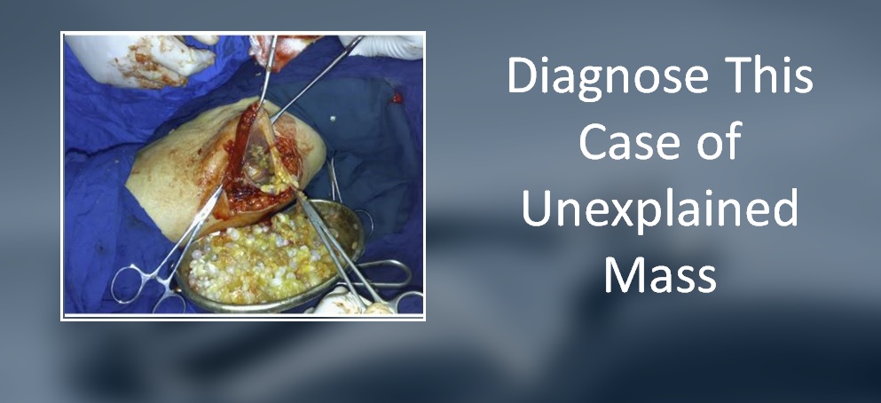 What Has Caused the Painless Mass in the Calf of This Patient?