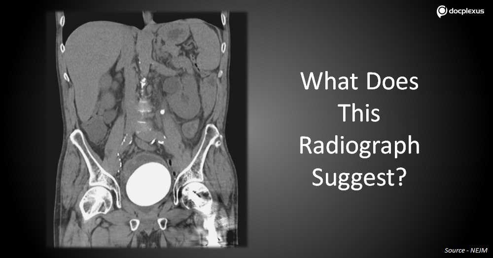 Decipher the Cause of Urinary Retention in This Case